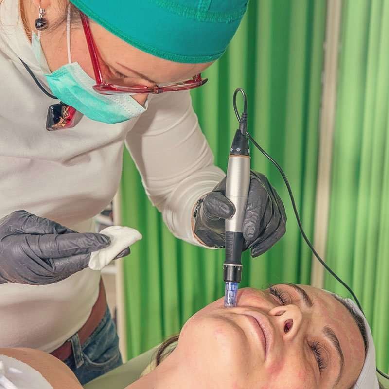 Bella Line – Microneedling